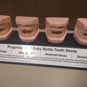 Tooth decay model